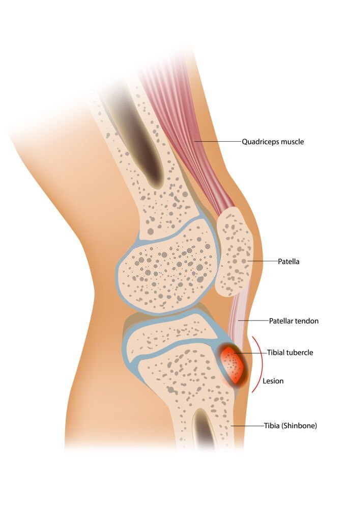 The Role of Knee Massagers in Managing Patellar Tendonitis